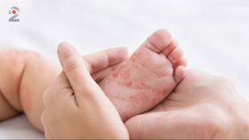 Epidemia de rujeolă face tot mai multe victime în România. 3 persoane au murit până acum din cauza bolii